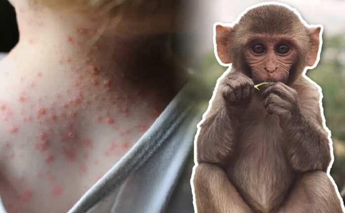 Salud confirma cuarto caso de viruela del mono en Honduras